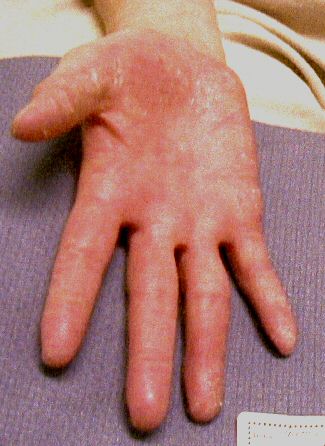 Hand with Eczema before treatment